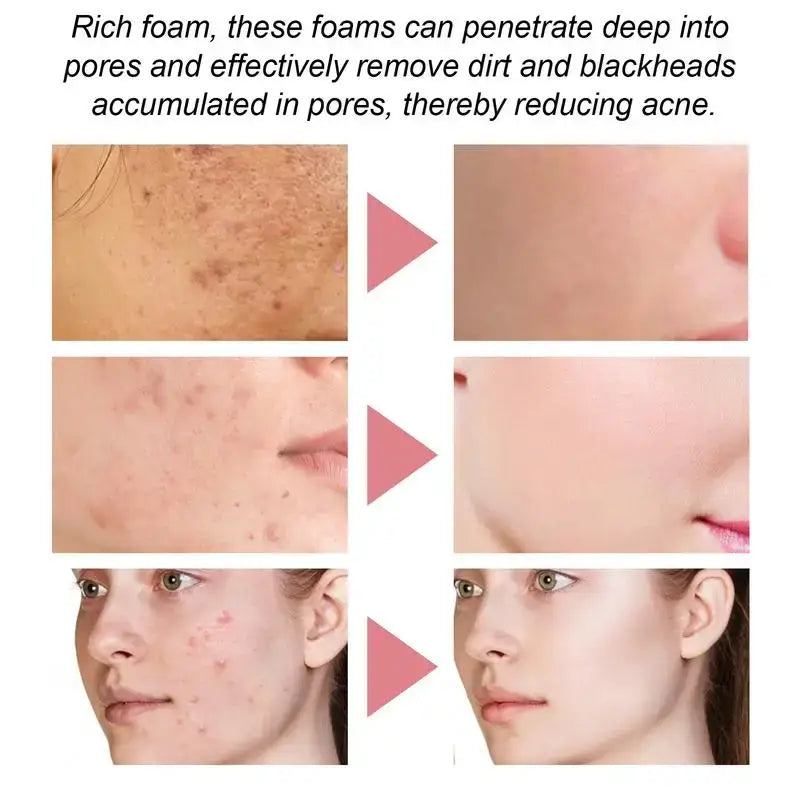 Before-and-after comparison of skin showing acne treatment results.