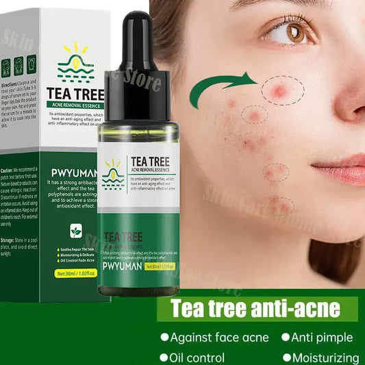 Tea tree anti-acne serum bottle with product packaging and skin treatment illustration.