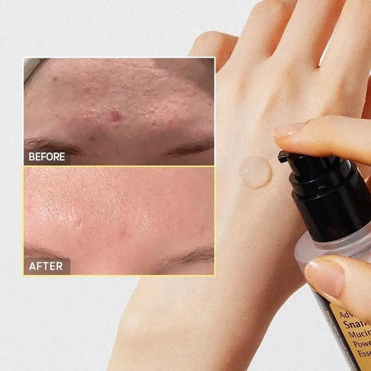 Skin treatment product with before and after comparison photos showing acne improvement.