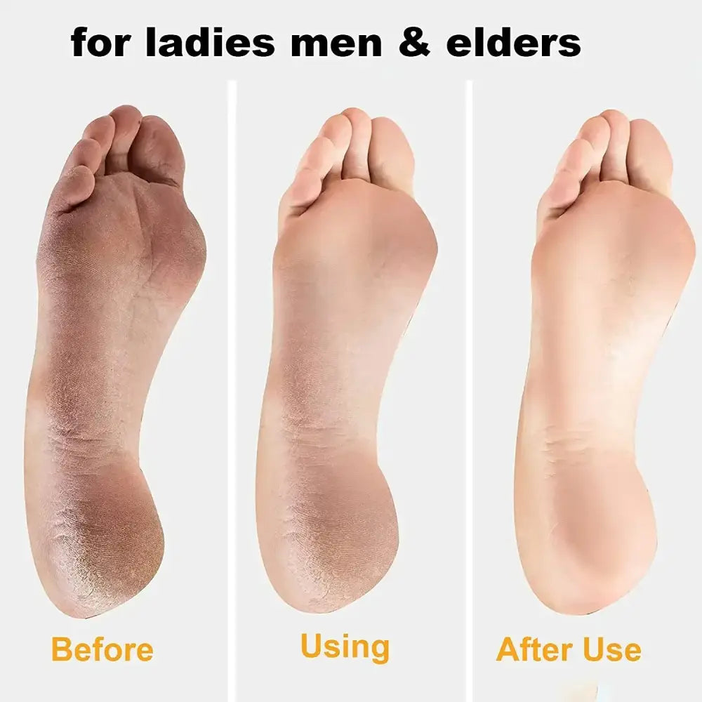 Three human feet showing progressive stages of skin condition improvement.