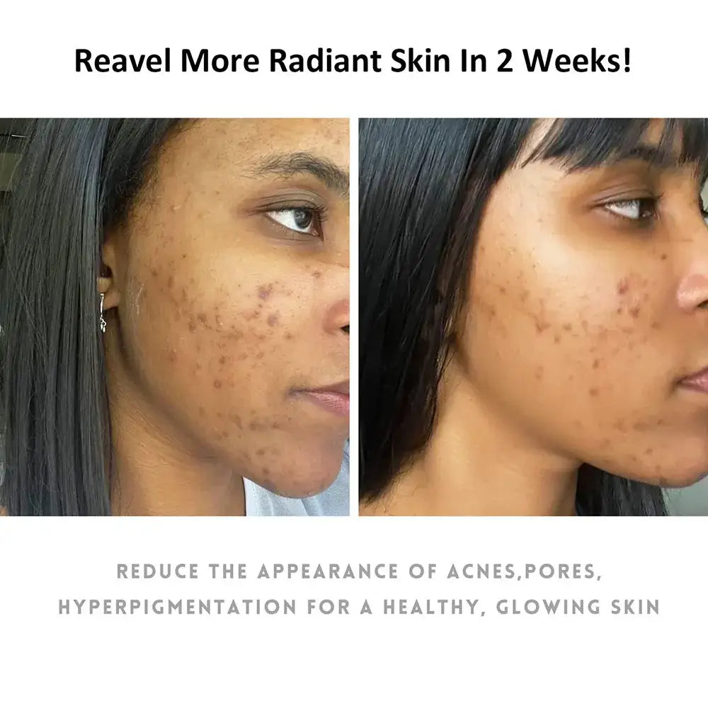 Before-and-after comparison of a person’s skin showing improvement in acne and hyperpigmentation.