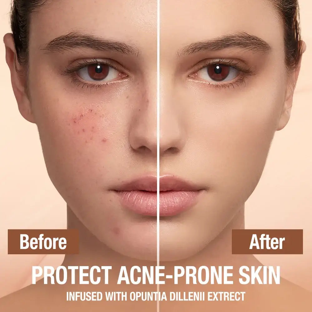 Split-screen comparison of a face showing acne treatment results, with ’Before’ and ’After’ sections.