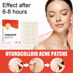 Hydrocolloid Acne Patches: Before & After - Vignette | VogueBeautify