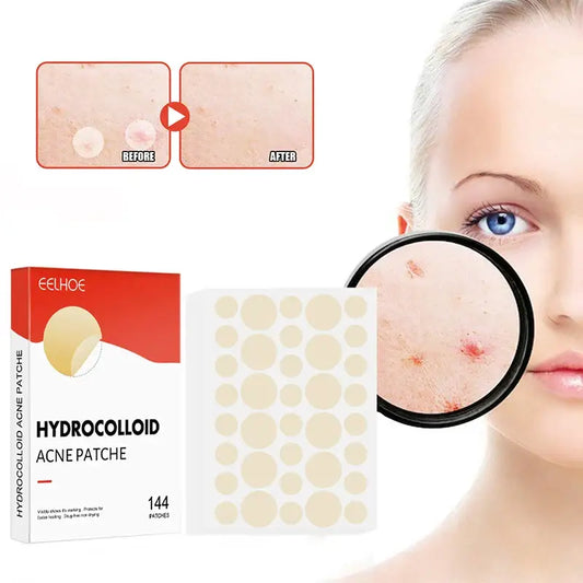 Hydrocolloid acne patches shown with product packaging and a demonstration of their use on facial skin.