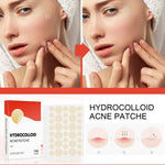 Hydrocolloid Acne Patches: Before & After - Vignette | VogueBeautify