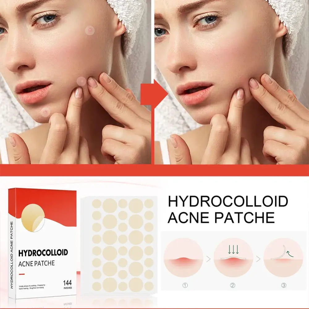 Hydrocolloid acne patches shown with before and after skin images and product packaging.