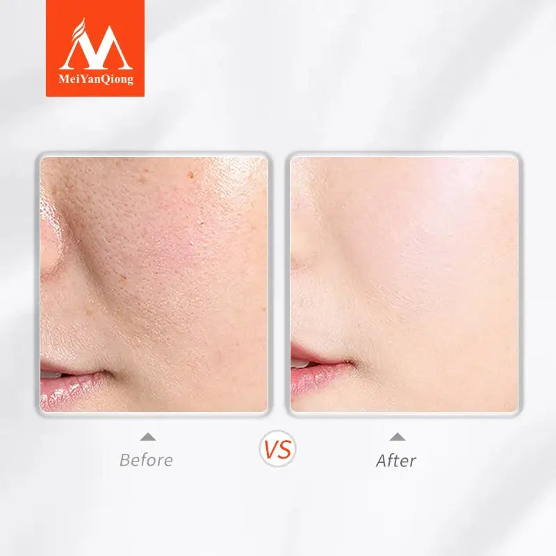 Before and after comparison of skin texture, showing reduced pores and smoother appearance.