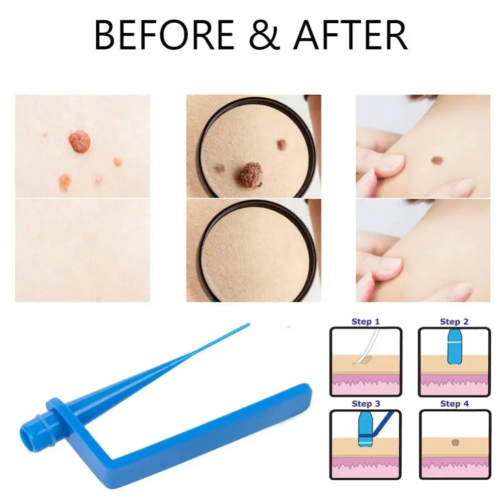 Blue plastic tool for removing skin tags or moles.