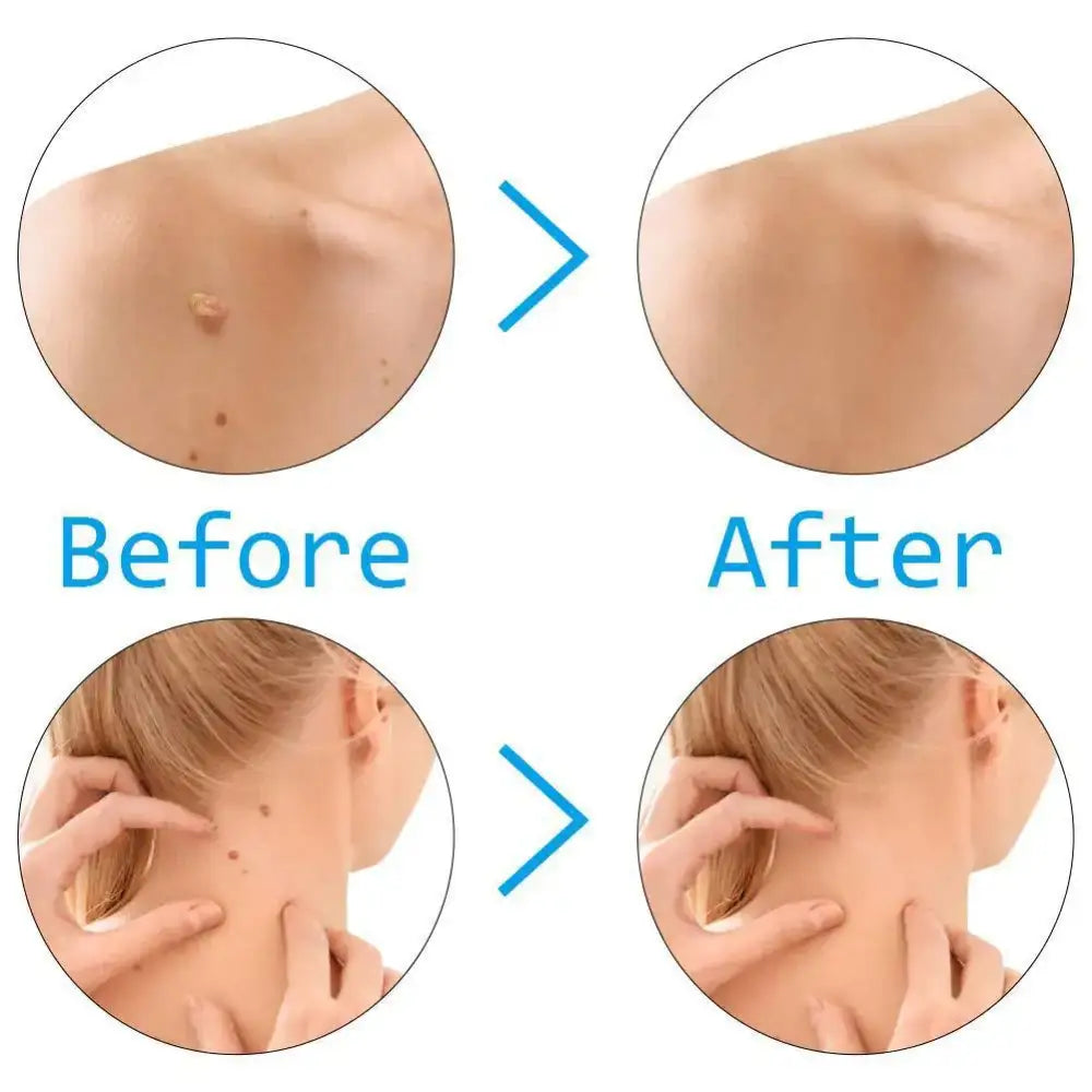 Before and after comparison of mole removal on skin.