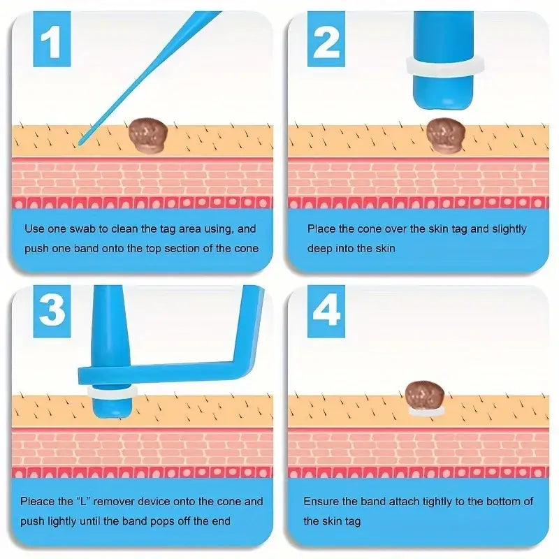 Four-step instructional diagram showing how to remove a skin tag using a cone-shaped device.