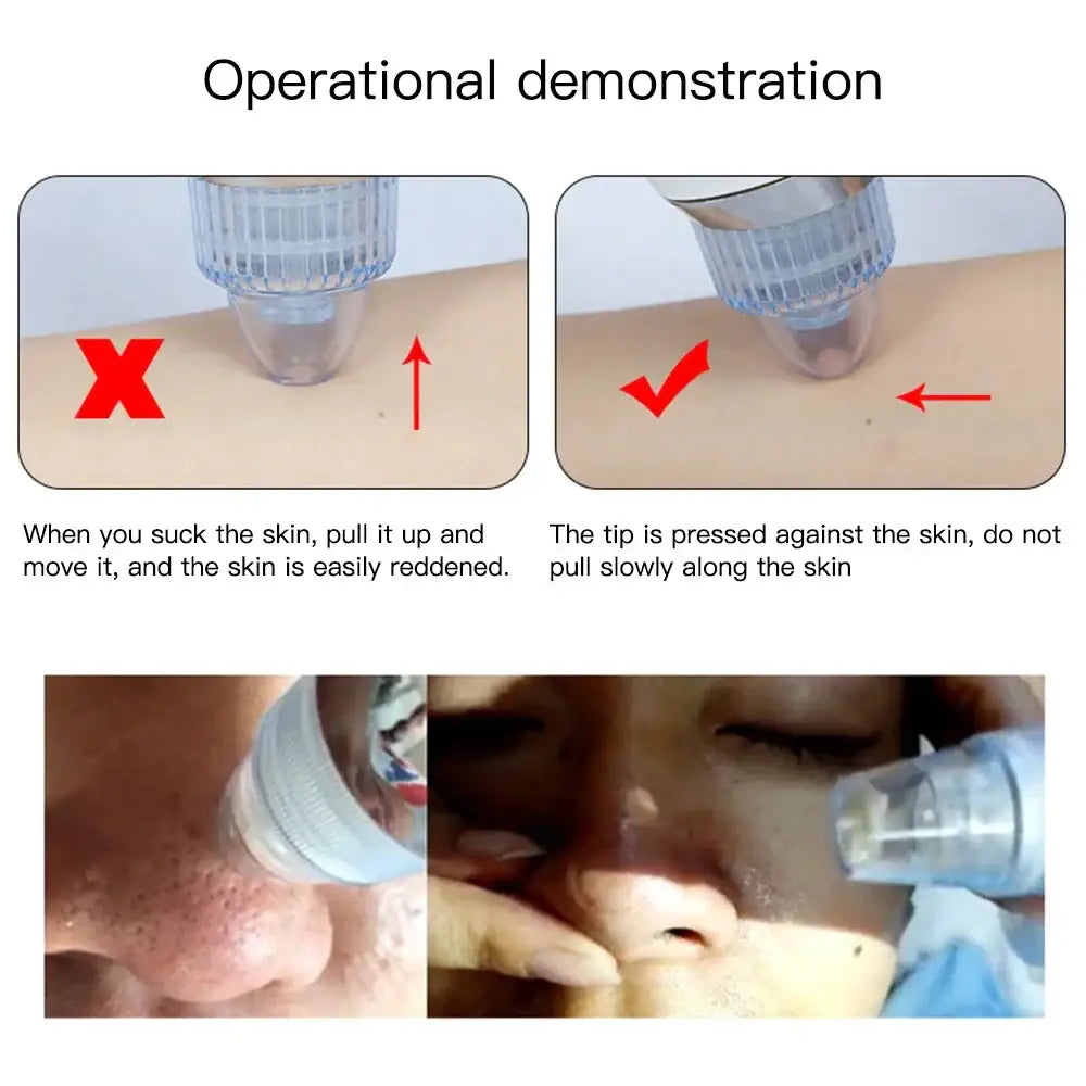 Operational demonstration of a skin suction device for facial treatment.