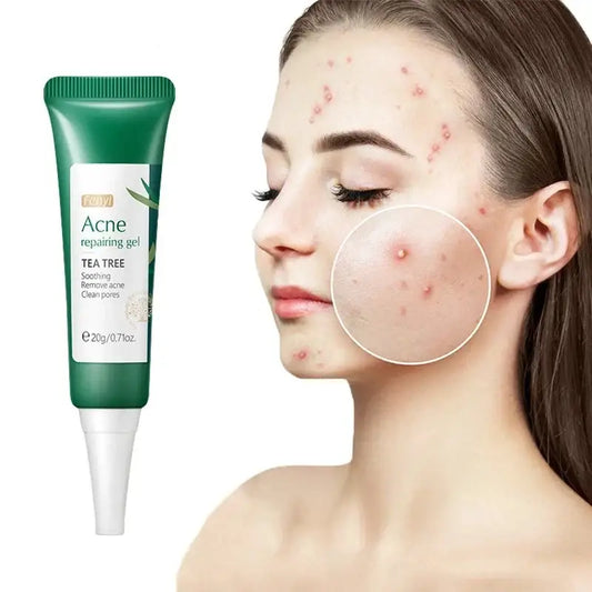 Acne treatment gel containing tea tree oil in a green tube.