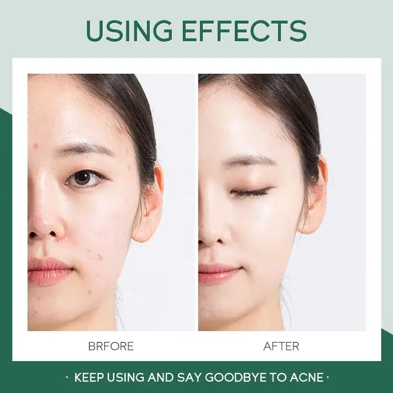 Before and after comparison of a person’s face showing acne treatment effects.