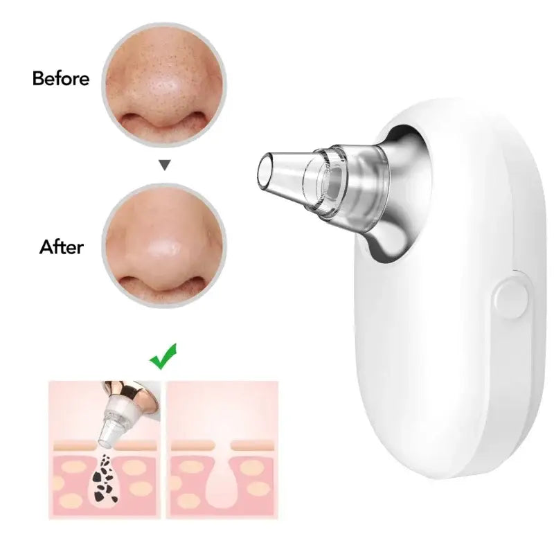 Handheld electronic nasal pore cleaner device with before and after images of nose pores.