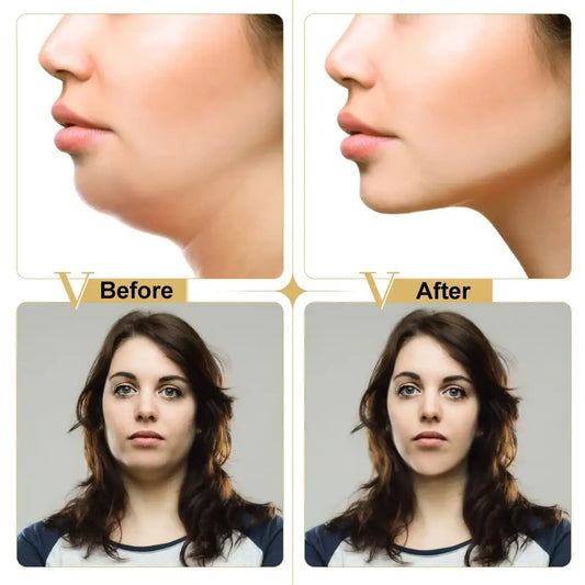 Before and after comparison showing facial profile changes and jawline contouring.